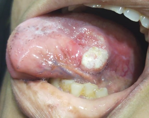 Oral Cancer Diagnosis